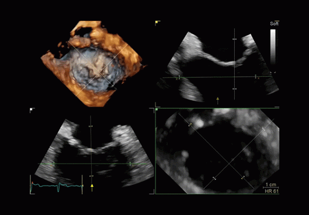 Клинические изображения Ультразвуковая диагностическая система GE HealthCare Vivid E95