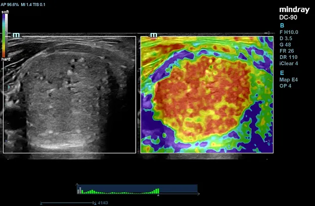 Клинические изображения УЗИ аппарат Mindray DC-90 Exp
