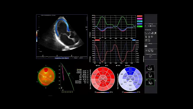 Клинические изображения Siemens Sequoia аппарат УЗИ