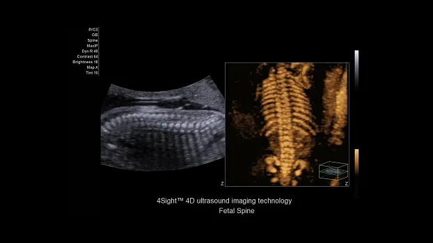 Клинические изображения Siemens Juniper УЗИ аппарат