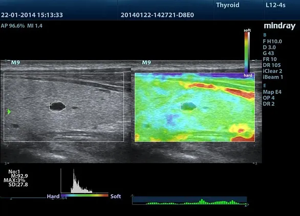Клинические изображения УЗИ аппарат Mindray M8 портативный