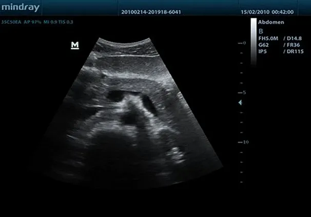 Клинические изображения УЗИ аппарат Mindray DC-7