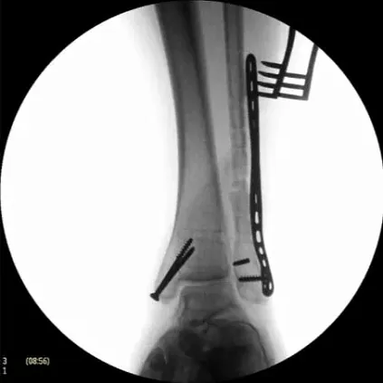 Клинические изображения Philips BV Endura С-дуга