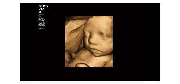 Клинические изображения Philips Affiniti 50 ультразвуковой аппарат