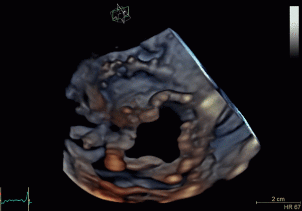 Клинические изображения Ультразвуковая диагностическая система GE HealthCare Vivid E95