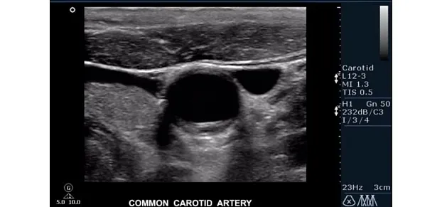 Клинические изображения Philips HD15 ультразвуковой аппарат