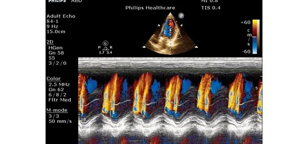 Клинические изображения Philips ClearVue 850 ультразвуковой аппарат