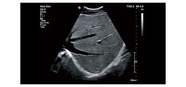 Клинические изображения Philips Affiniti 50 ультразвуковой аппарат