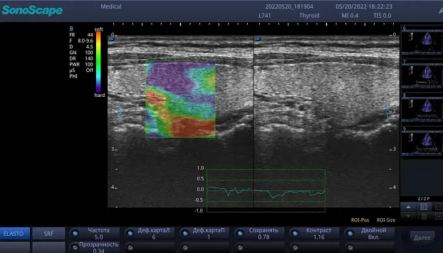 Клинические изображения Sonoscape E3 ультразвуковой аппарат
