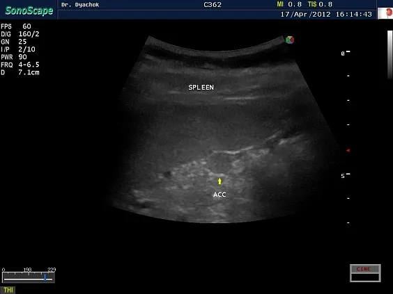 Клинические изображения Sonoscape S40 Exp ультразвуковой аппарат