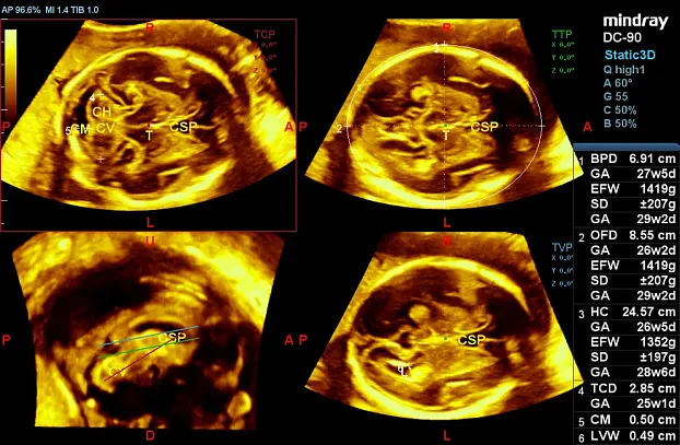 Клинические изображения УЗИ аппарат Mindray DC-90 Exp