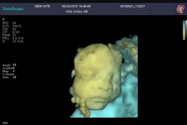 Клинические изображения Sonoscape S60 ультразвуковой аппарат