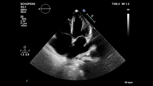 Клинические изображения Philips EPIQ 5 ультразвуковой аппарат