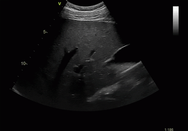 Клинические изображения УЗИ аппарат GE HealthCare Vivid E90