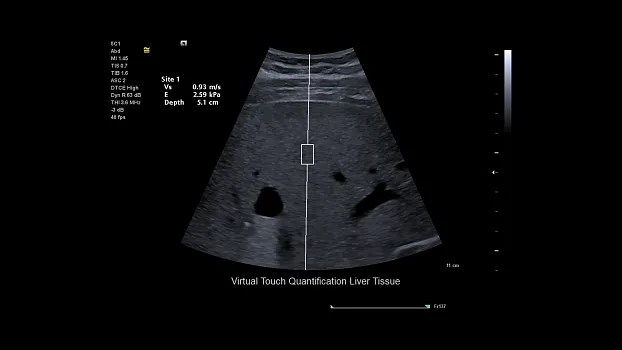 Клинические изображения Siemens Juniper УЗИ аппарат