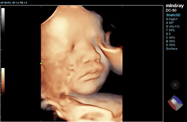 Клинические изображения УЗИ аппарат Mindray DC-90 X-Insight
