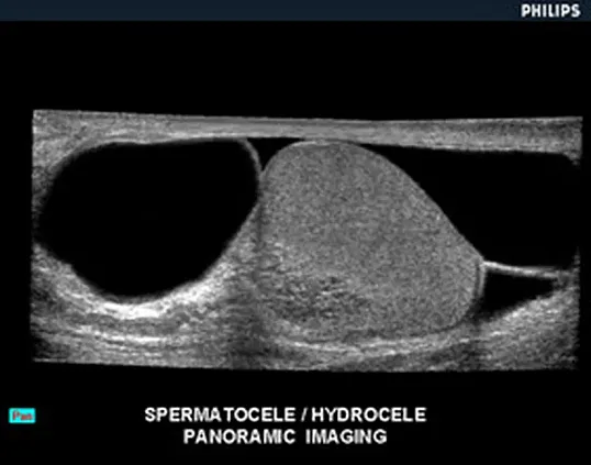 Клинические изображения Philips HD11 XE ультразвуковой аппарат