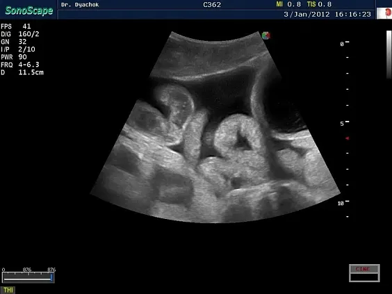 Клинические изображения Sonoscape S20 ультразвуковой аппарат