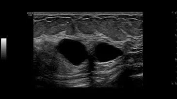 Клинические изображения GE HealthCare Logiq E10 ультразвуковая система