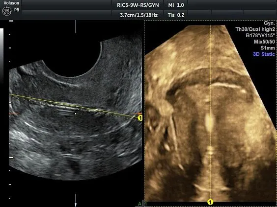 Клинические изображения УЗИ аппарат GE HealthCare Voluson P8