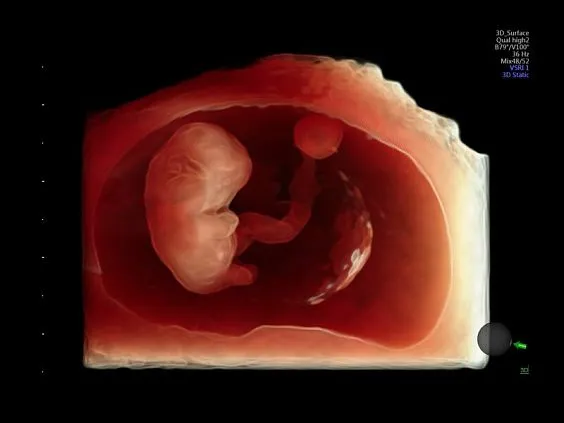 Клинические изображения Ультразвуковая диагностическая система GE Voluson E10