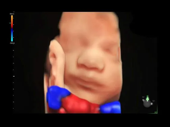 Клинические изображения Ультразвуковая диагностическая система GE Voluson E10