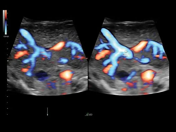 Клинические изображения Ультразвуковая диагностическая система GE Voluson E10