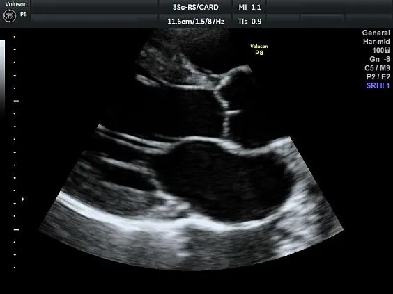 Клинические изображения УЗИ аппарат GE HealthCare Voluson P8