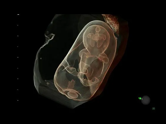 Клинические изображения Ультразвуковая диагностическая система GE Voluson E10