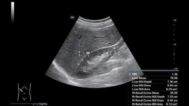 Клинические изображения УЗИ аппарат Mindray Consona N6