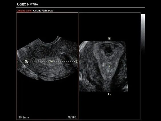Клинические изображения Samsung Medison HM70 EVO УЗИ аппарат портативный