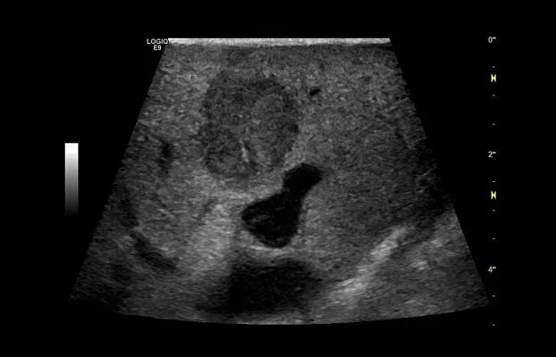 Клинические изображения GE Logiq P9 ультразвуковая диагностическая система