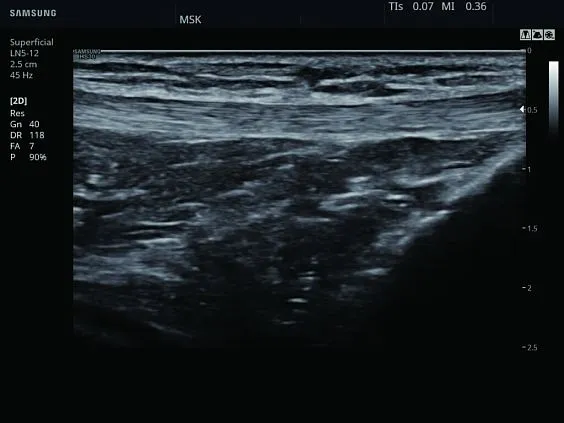 Клинические изображения Samsung Medison HS30 УЗИ аппарат