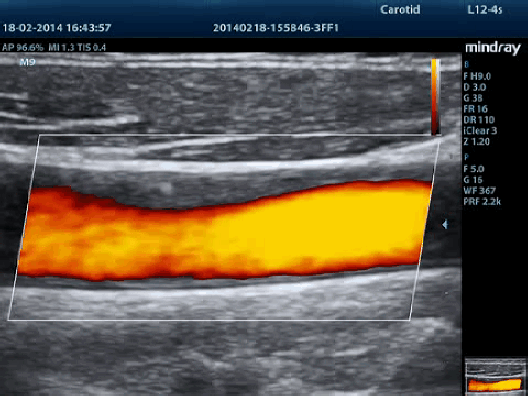 Клинические изображения УЗИ аппарат Mindray M9 портативный