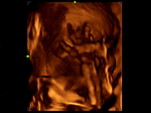 Клинические изображения УЗИ аппарат Mindray Z60 портативный