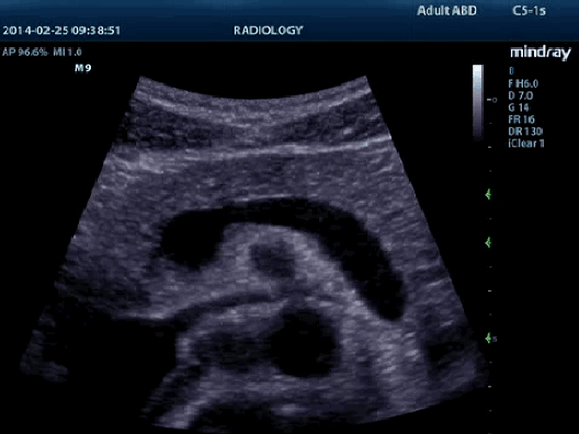 Клинические изображения УЗИ аппарат Mindray M9 портативный