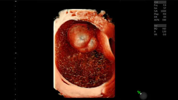 Образование яичника с 3D визуализацией методом HDlive, RIC5-9-D